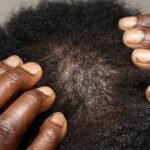 Scalp Sun Guard: The Overlooked Shield Your Hairline Actually Needs