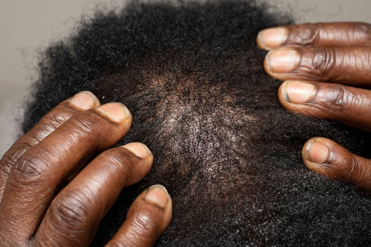 Scalp Sun Guard: The Overlooked Shield Your Hairline Actually Needs